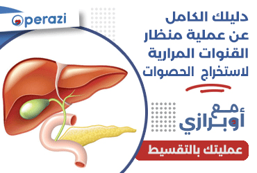 دليلك الكامل عن عملية منظار القنوات المرارية لاستخراج الحصوات